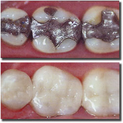 White-composite-fillings